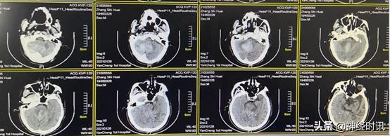 高血压小脑出血治愈率多大,高血压导致小脑出血