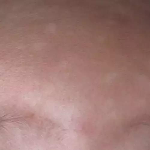 中年脸上长白斑的原因,8岁脸上长白斑怎么回事