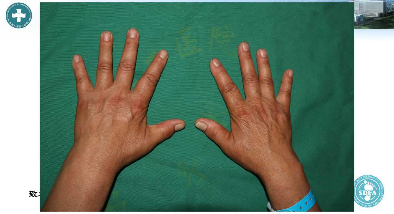 肾病综合征抽血生化报告单怎么看,肾病综合征检查血液哪些指标