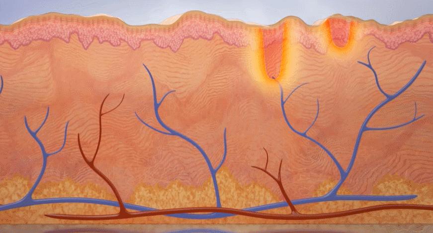 毛孔粗大怎么办方法其实很简单,毛孔粗大怎么办教你两招解决问题