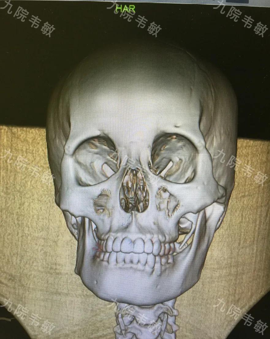 左右脸不对称怎么矫正最好看,如何纠正天生左右脸不对称的问题