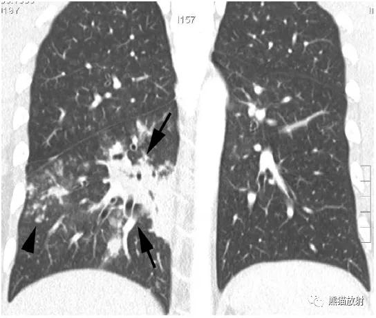 肺部感染并发症,老人新冠引起肺部并发症