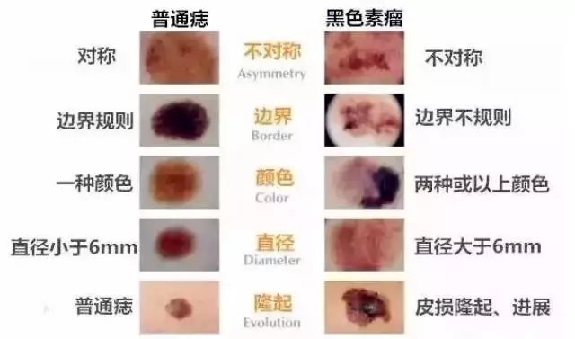 「健康」人无大“痣”,未必不是好事