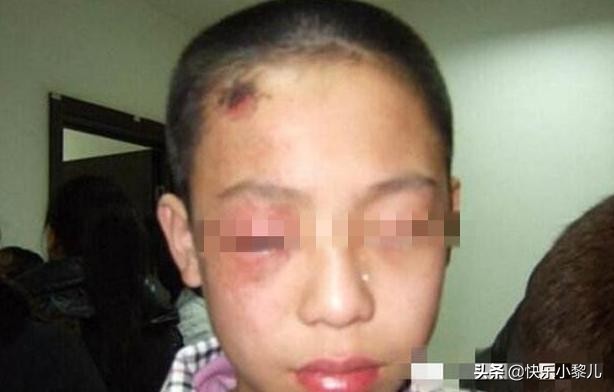 孩子玩干燥剂眼睛被溶解,孩子玩荧光棒水进眼睛