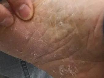 沈腾说醋的真实效果,沈腾治疗痘痘