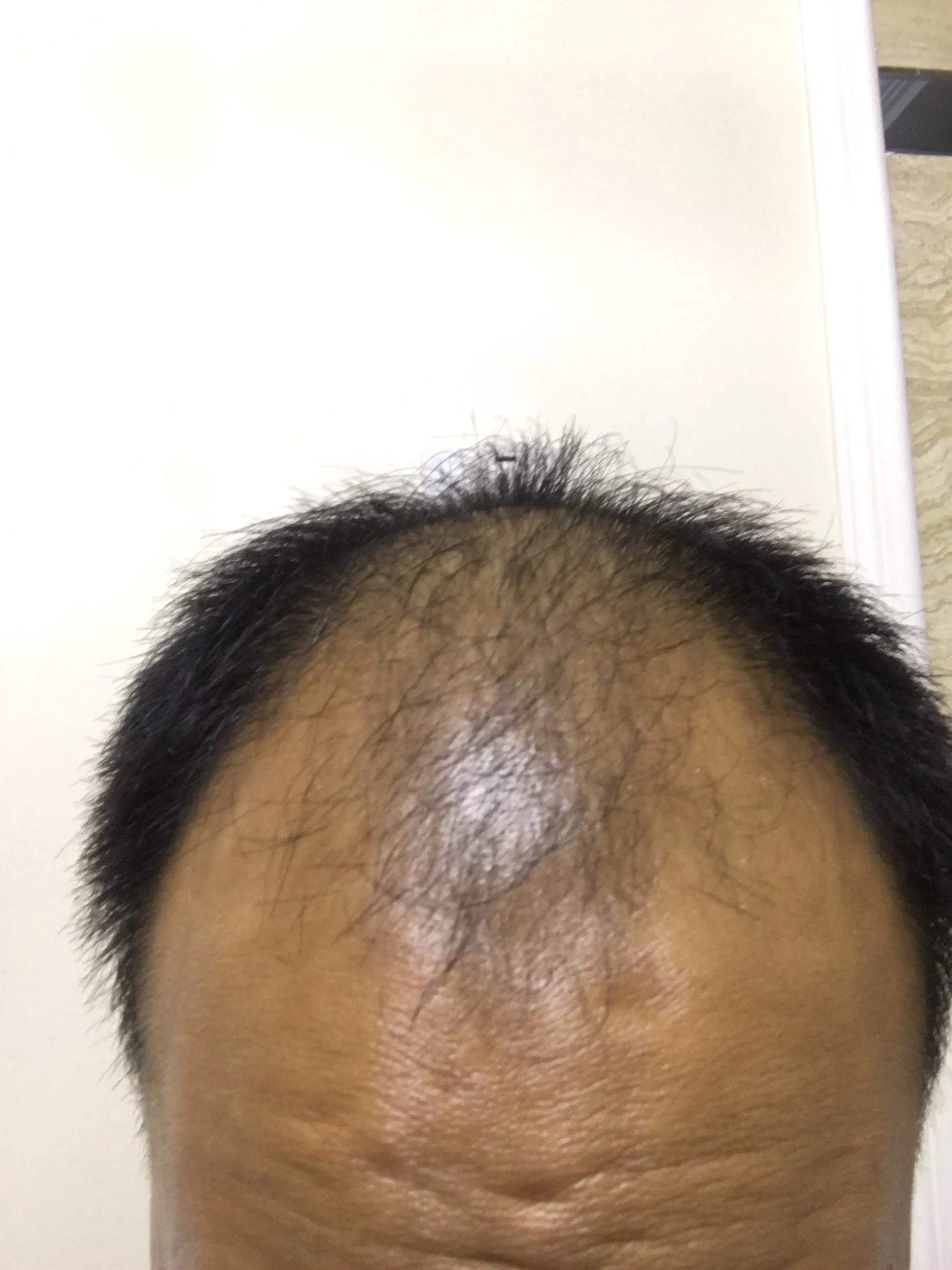 有谁治好了脂溢性脱发,脂溢性脱发用什么洗头