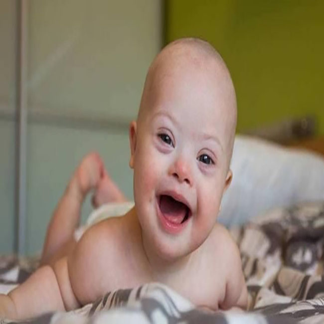 为什么大龄孕妇会容易生唐氏儿,妈妈怀了唐氏儿的孩子怎么办