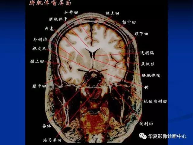 电子版头颅ct与mri断层解剖,头颅mri血管解剖与分段详解