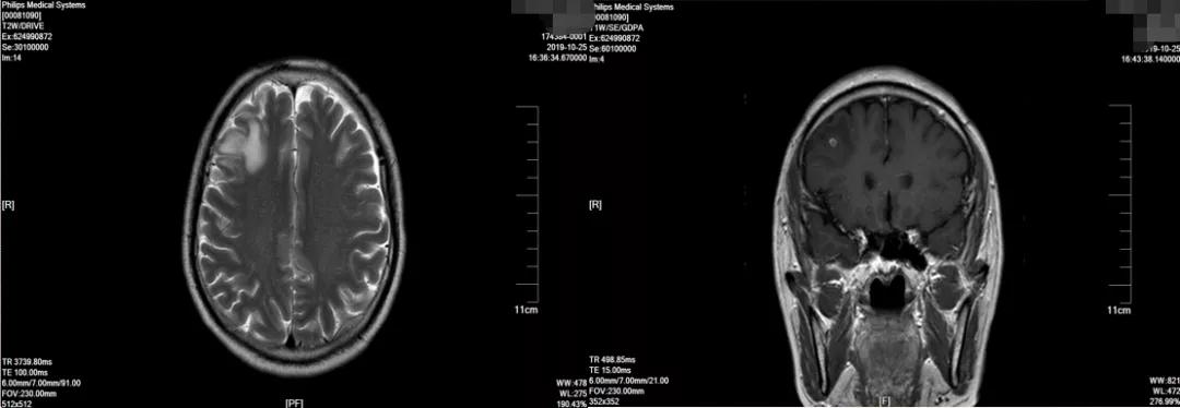 肺癌晚期可以靶向加免疫治疗吗,肺癌晚期化疗加免疫治疗有效吗