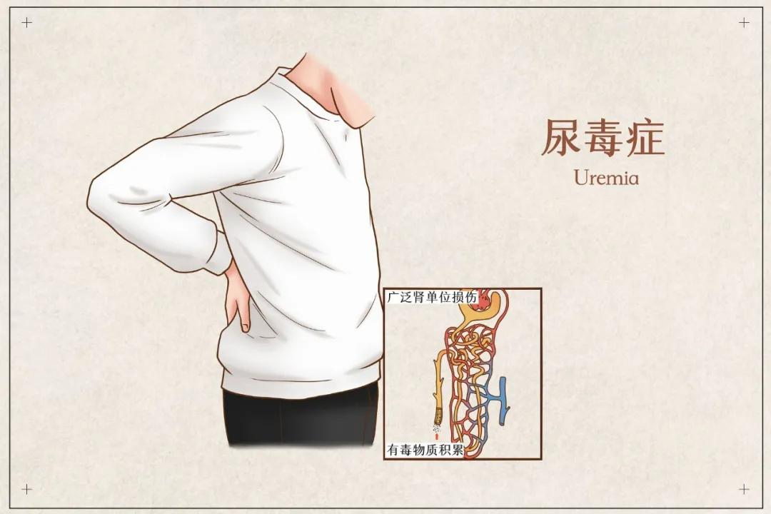 尿毒症导致的不宁腿怎么治疗,不宁腿综合征会得尿毒症