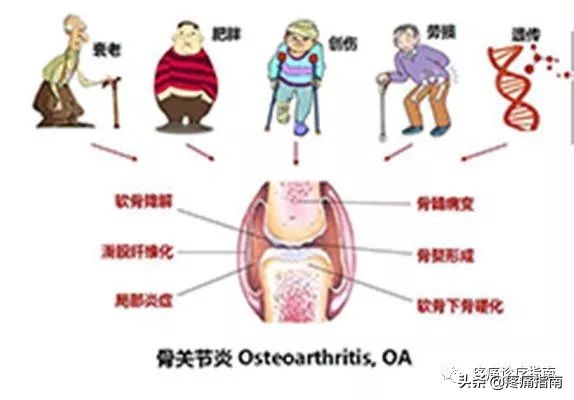 骨性关节炎诊疗指南2019解读,骨性关节炎的护理诊断和措施