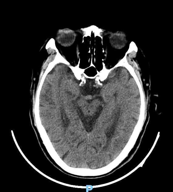 老年人基底动脉瘤几率,脑动脉瘤未破裂最佳治疗方法