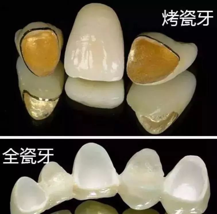 13岁根管治疗的牙齿需要做牙冠吗,13岁牙齿根管治疗后需要做牙冠吗