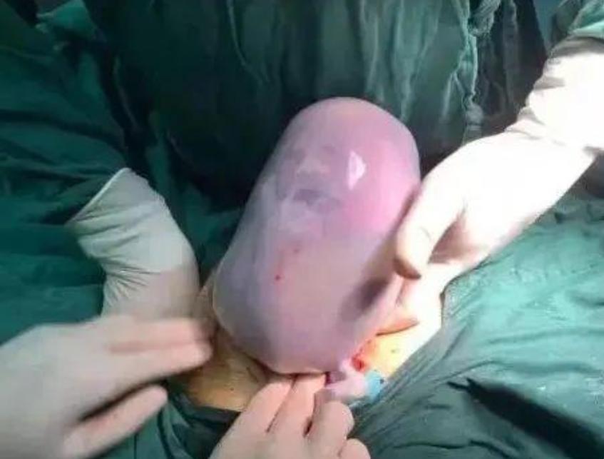 90后宝妈生下3胞胎,90后的宝妈生宝宝