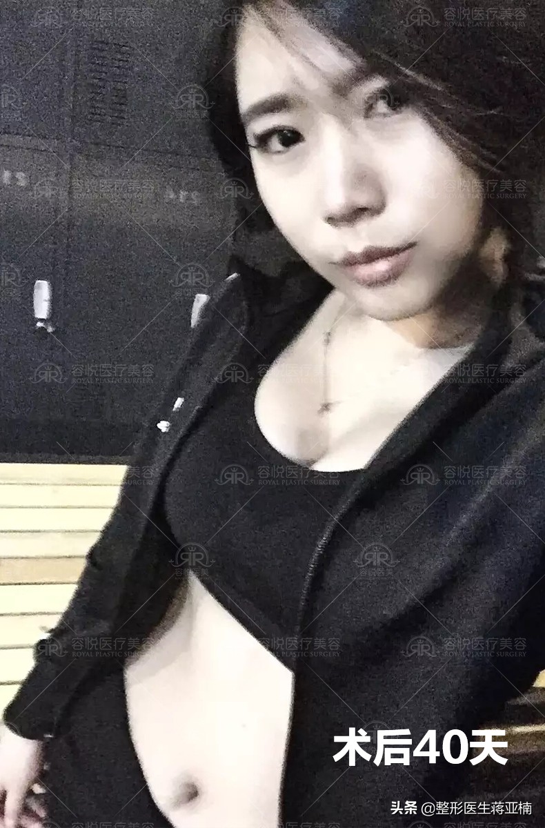 全身吸脂18斤需要多少钱,8000的面部吸脂