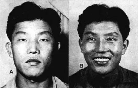 双眼皮真的有那么漂亮吗,自然双眼皮和割的双眼皮内在区别