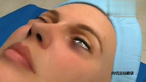 “祛眼袋”这件事,您试过几种妙招?说实话“还是手术靠谱”