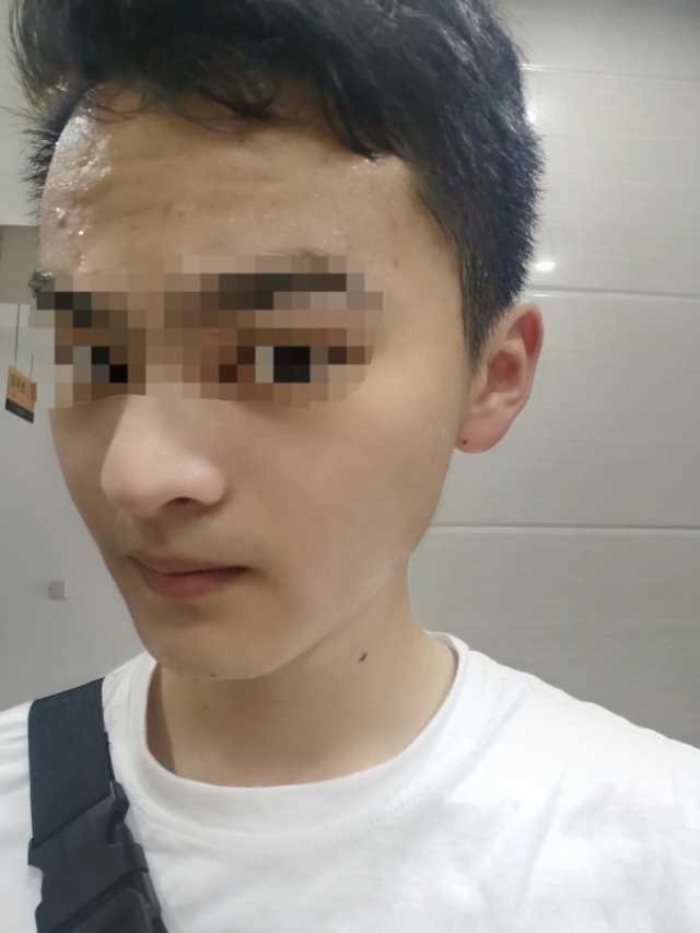 痘印是怎么出来的,痘印是怎么生成的