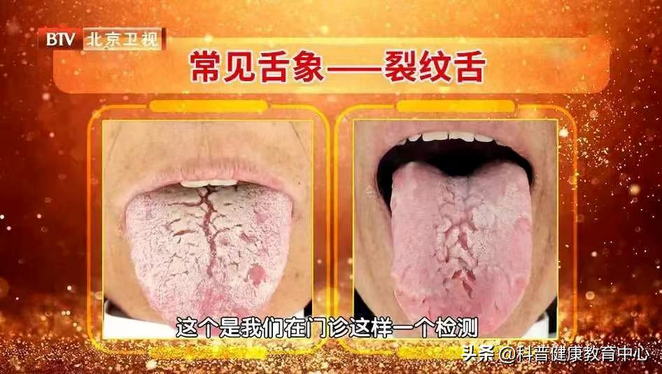 口腔溃疡反反复复什么原因,口腔溃疡反反复复是缺什么