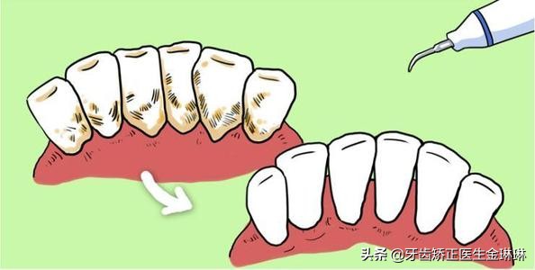 洗牙后牙难受怎么回事,洗牙后牙齿酸软是什么原因