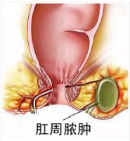 怎么判断自己是否有hpv,怎么判断自己是否有耳结石