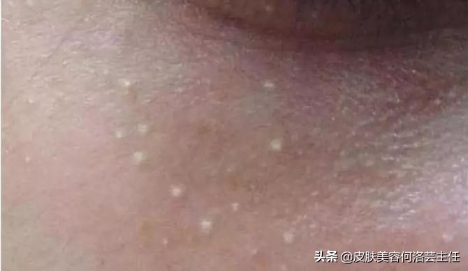 脂肪粒形成的原因和消除方法,脂肪粒是什么原因造成的怎么治