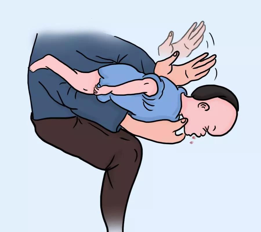 食物卡喉怎么办？这个救命技能人人都该会