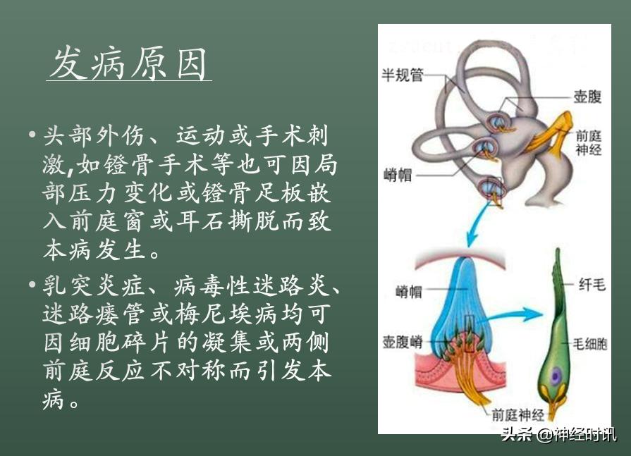 良性位置性眩晕诊断和治疗指南,良性阵发性位置性眩晕的诊断标准