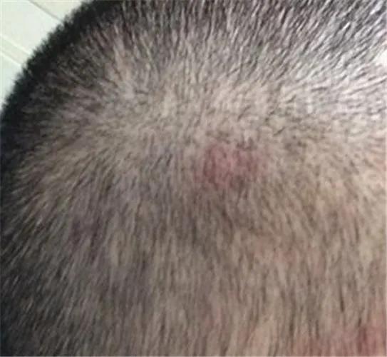 头皮穿凿性毛囊炎如何根治,头皮毛囊炎可以根治吗该如何治疗