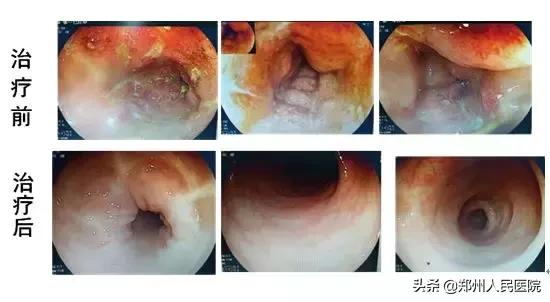 孩子得了炎症性肠病怎么办,炎症性肠病什么东西不能吃