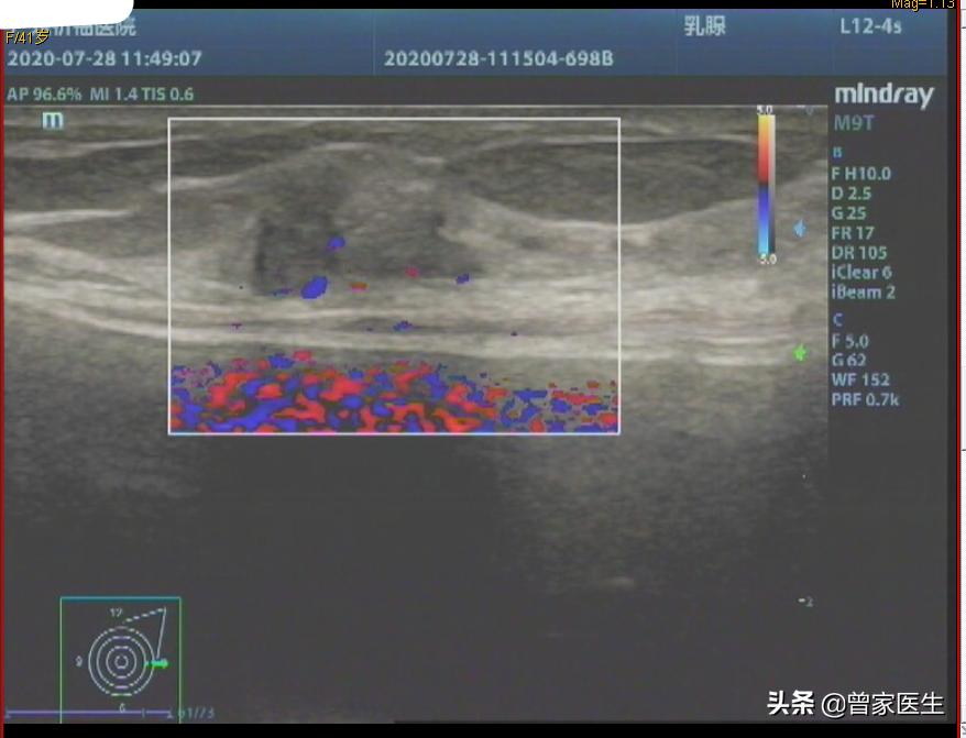 乳腺检查bi-rads4a严重么,乳腺彩超4a纵横比大于1