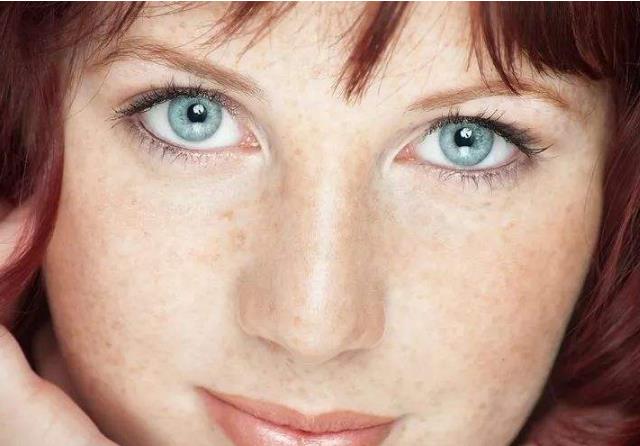 女人脸上长黄斑的原因和调理方法,女性绝经后脸上出现雀斑怎么调理