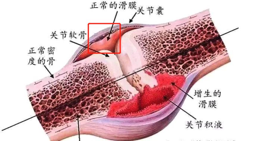 膝盖有滑膜炎要紧吗,膝盖有滑膜炎怎么治疗