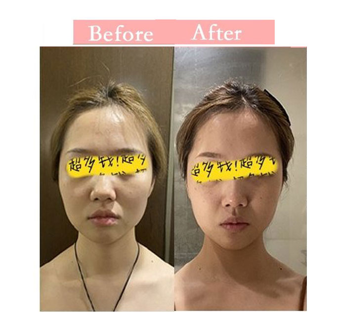 颧骨不一般高怎么矫正,颧骨紊乱的症状和矫正