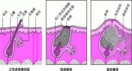 得了疮会有哪些症状,得了疮怎么消肿