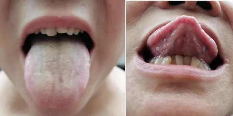 国医大师讲耳鸣治疗,干祖望治疗耳鸣医案