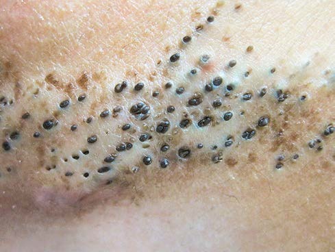 如何分辨痘痘的类型和长痘的原因,如何判断自己长的痘痘是哪种痘痘