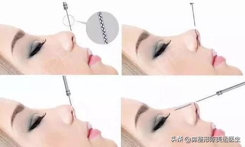 为什么医生都反对线雕隆鼻,到底要不要做线雕隆鼻