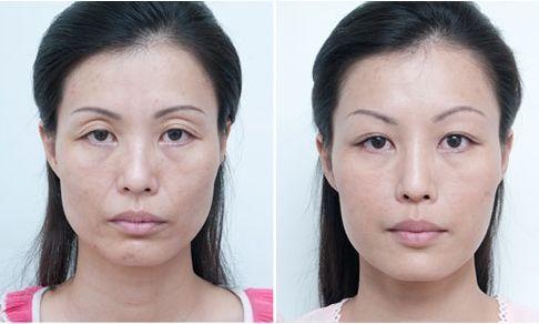 美白针是违法的吗,美白针出事的几率