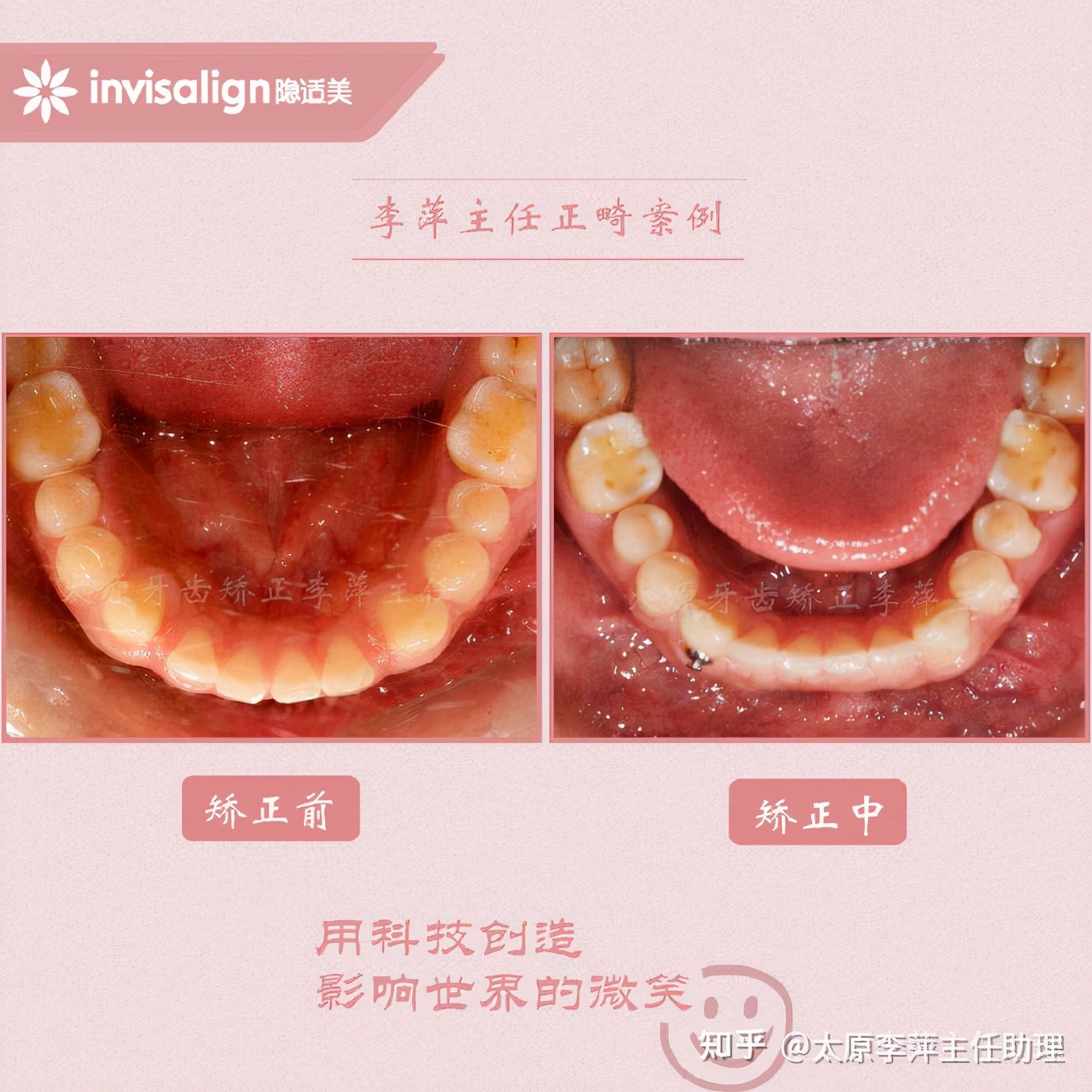 太原牙齿矫正靠谱吗,太原成人隐形牙套牙齿不齐
