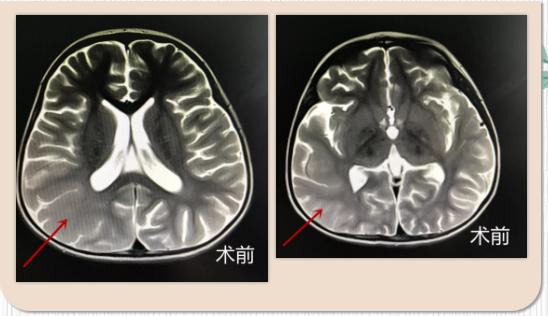 孩子癫痫发作后头痛是怎么回事,家长如何及早发现癫痫儿童的症状