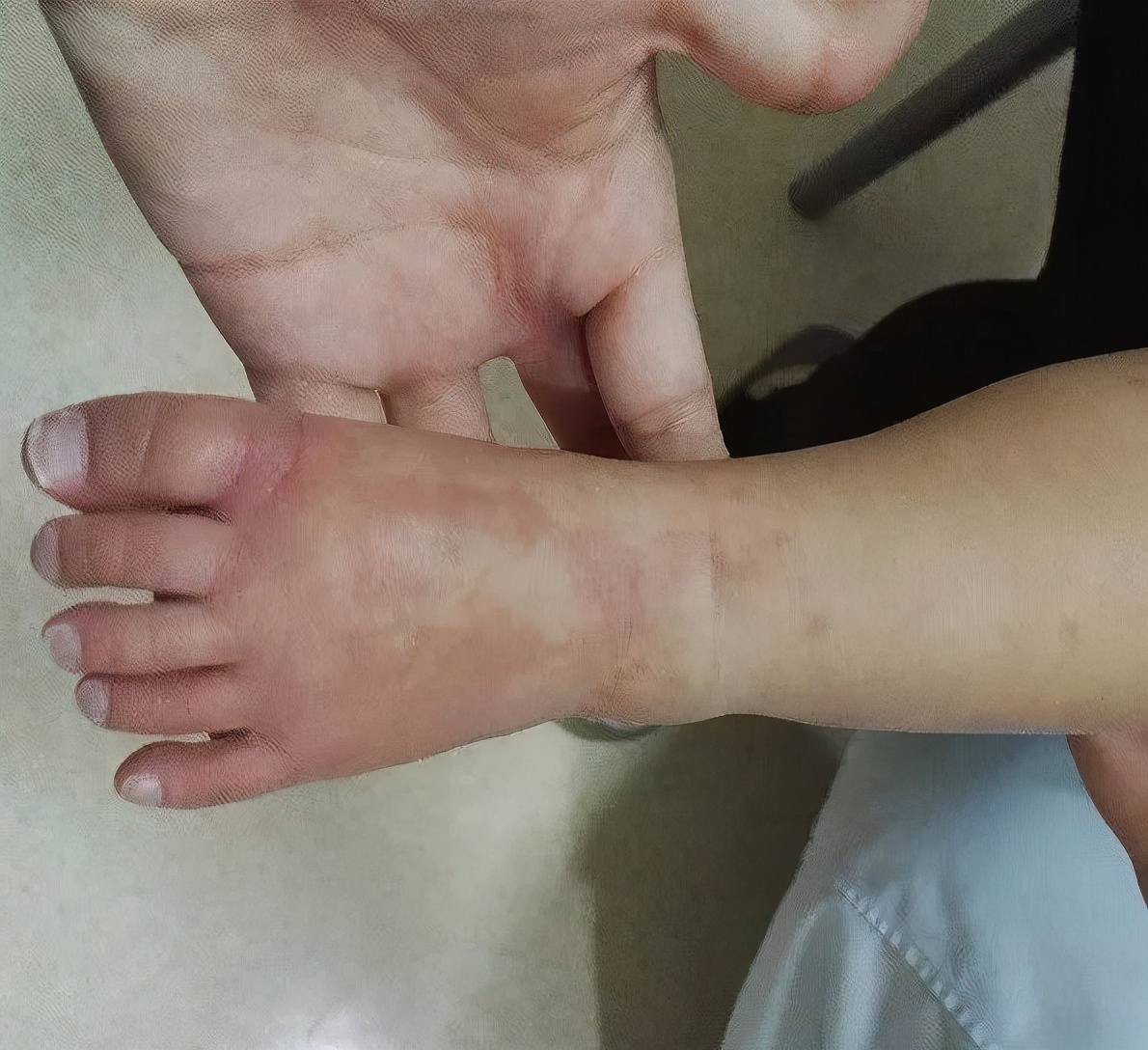 孩子反复高烧是吓到了吗,儿童高烧反复要警惕什么病