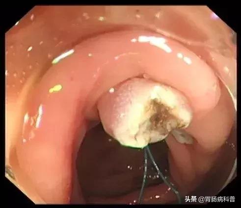 只要是肠息肉都要割掉吗,医生肠息肉切除后怎么处理伤口