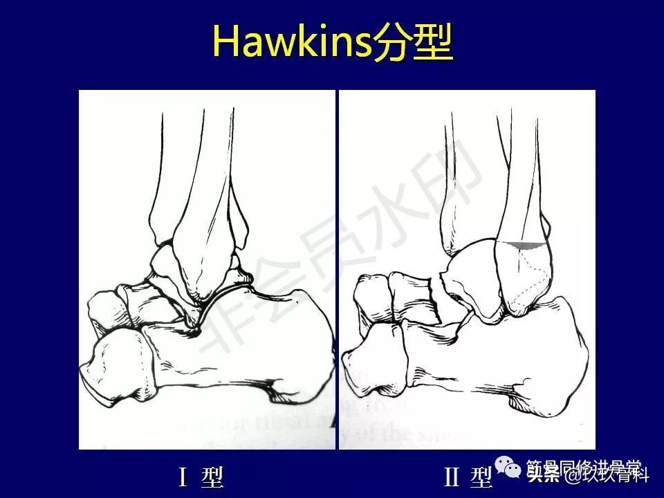 距骨骨折后遗症,距骨骨折怎么办