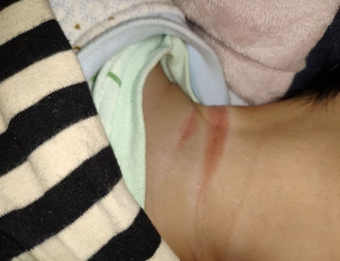 宝宝淹脖子导致破皮抹什么好得快,婴儿脖子淹了破皮可以擦紫草油吗