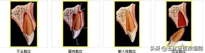 牙齿磕掉了怎么办大班安全教案,牙齿磕掉了怎么办幼儿动画
