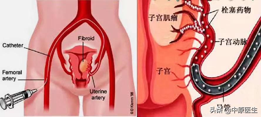 宫颈鳞癌需要切除哪里,宫颈鳞癌出血怎么处理