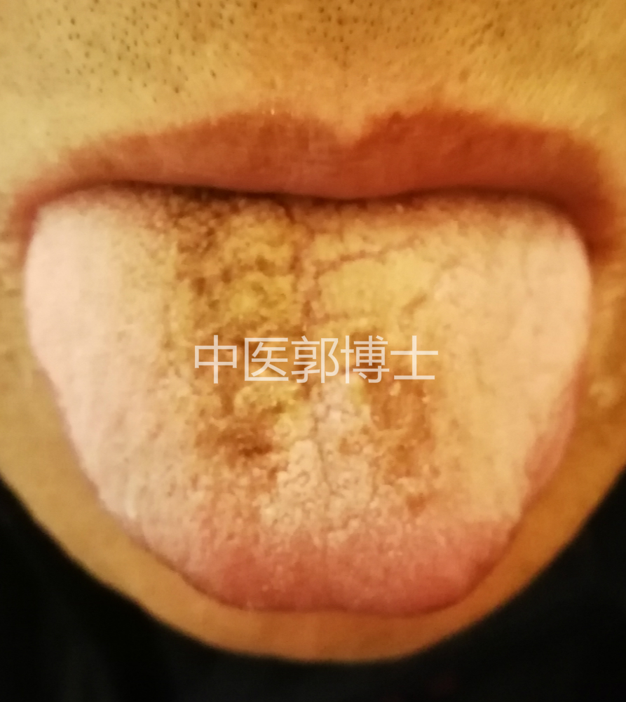男人睾丸潮湿吃龙胆泻肝丸,老人怕冷有湿热能否食龙胆泻肝丸