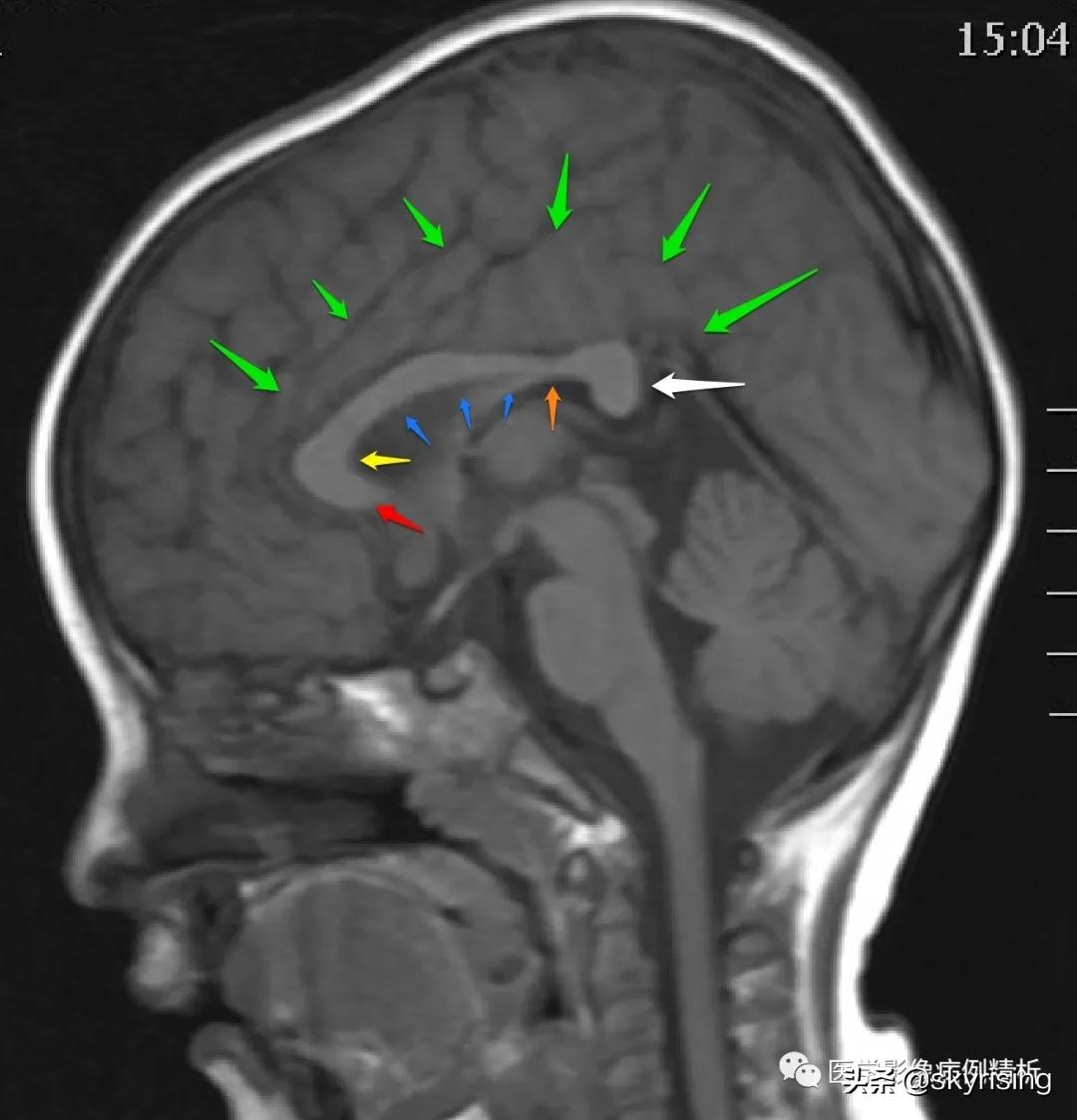 半叶全前脑畸形,无叶型前脑无裂畸形超声表现