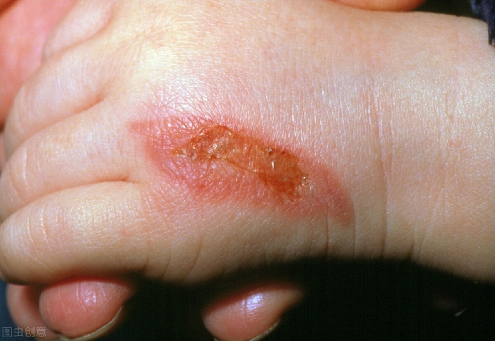 预防儿童烫伤的十大注意事项,对儿童烫伤的急救原则